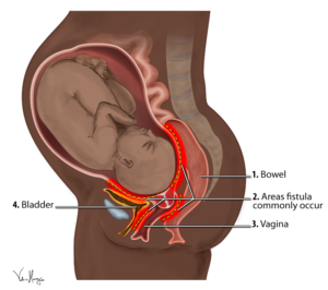 obstetric-fistula-diagram